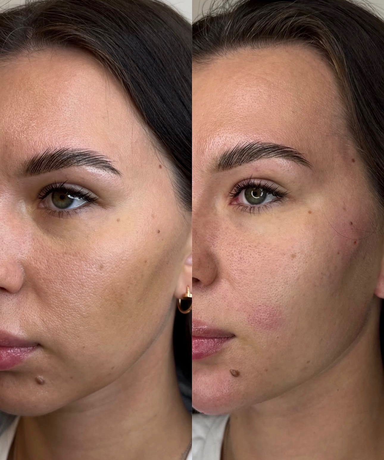 Antes e Depois — Resultado Estético