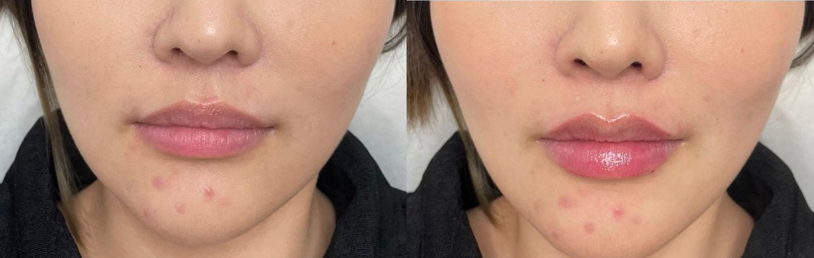 Antes e Depois — Harmonização Labial